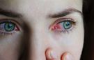 Kırmızı göz hastalığı nedir? Kırmızı göz hastalığı nedenleri, belirtileri ve tedavi yolları