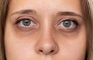 Göz altı morlukları neden olur? Göz altı morlukları nasıl geçer?