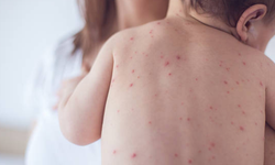 Alerjisi olanlara kızamık aşısı nasıl yapılmalı?