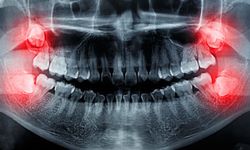 20'lik diş ağrısına hızlı çözüm: Evde bunu yaparak diş ağrısını durdurun!