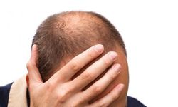 Saç Dökülmesi: Nedenleri ve Engelleme Yolları