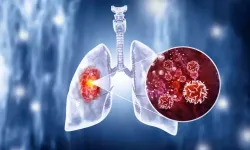 Geçmeyen Öksürük ve Nefes Darlığı Varsa Akciğer Kanserinden Şüphe Edilmeli