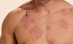 Kelebek Hastalığı (Lupus) hastalığı nedir? Kelebek Hastalığı tedavi edilir mi, belirtileri neler?
