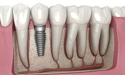 Emeklilere implant ücretsiz mi?