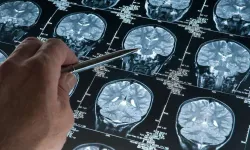 Alzheimer riskini artıran genetik varyant bulundu!