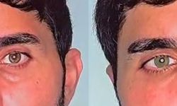 Göz Renginizi Kalıcı Olarak Değiştirmek Artık Mümkün!