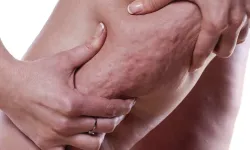 Diyet ve spora rağmen gitmeyen inatçı yağların ardındaki sır: Adı konulmamış hastalık Lipödem