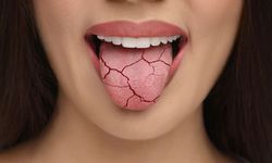 Dilinizdeki çatlaklar masum olmayabilir: Her 10 kişiden ikisinde görülen bu belirti ciddi hastalıkların habercisi