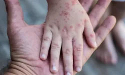 Kızamık alarmı: Son 30 yılın en büyük salgını can kayıplarıyla büyüyor