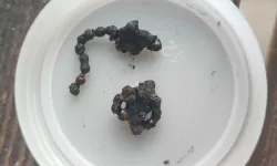 5 yaşındaki çocuğun burnundan çıktı!