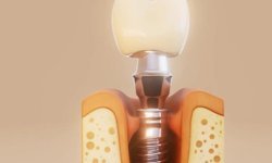 Diş İmplantı Kimler İçin Uygundur?