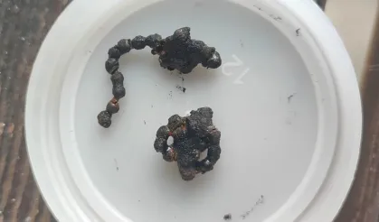 5 yaşındaki çocuğun burnundan çıktı!