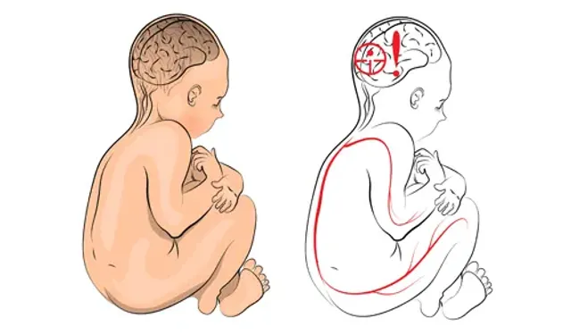 Serebral Palsi Nedir? Neden Olur, Tedavisi Var mı?