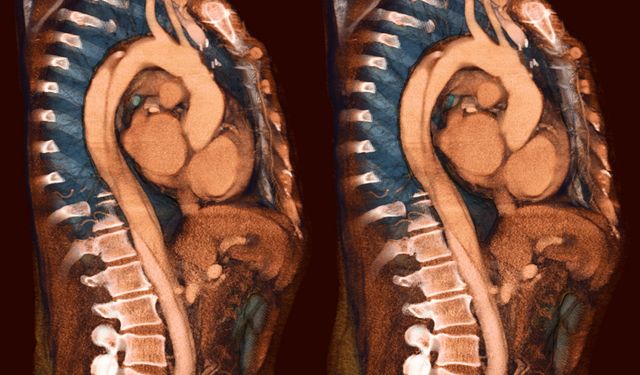 Diseksiyon nedir? Aort diseksiyonu ve anevrizma arasındaki farklar