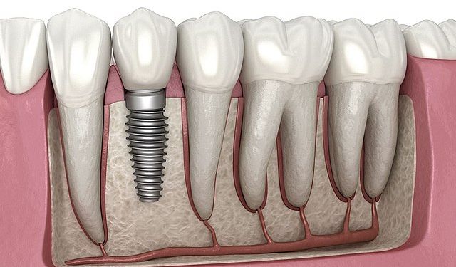 Emeklilere implant ücretsiz mi?