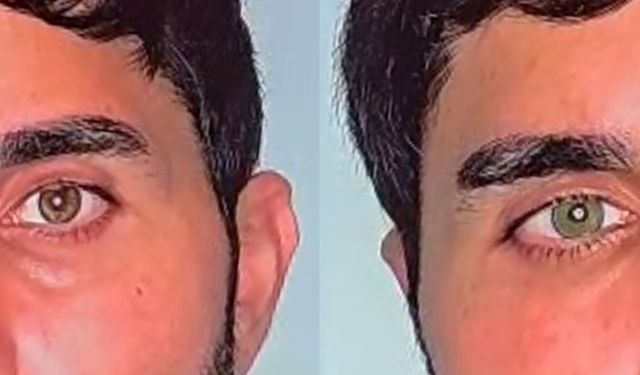 Göz Renginizi Kalıcı Olarak Değiştirmek Artık Mümkün!
