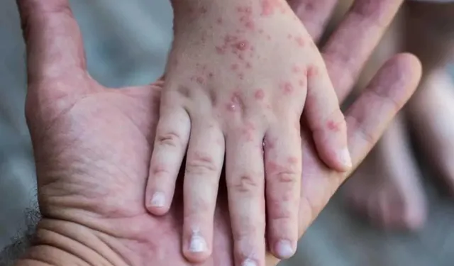 Kızamık alarmı: Son 30 yılın en büyük salgını can kayıplarıyla büyüyor