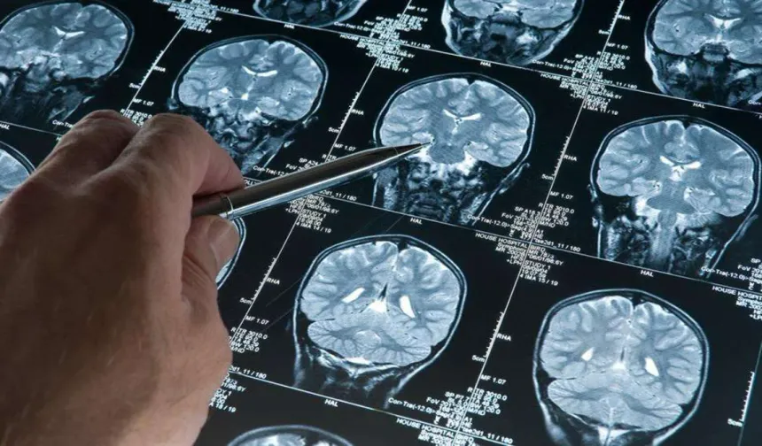 Alzheimer riskini artıran genetik varyant bulundu!
