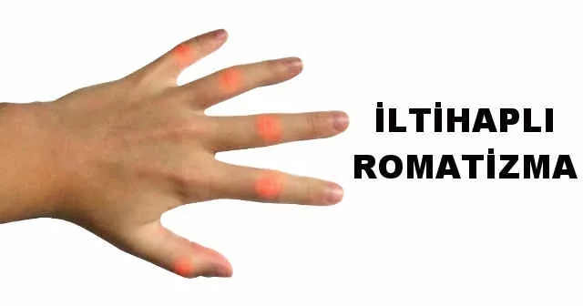 İltihaplı romatizma için hangi doktora gidilir?
