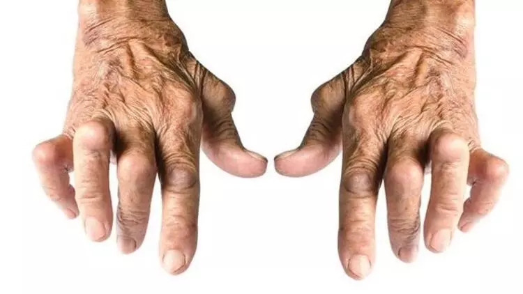 İltihaplı Romatizma Nasıl Tedavi Edilir?