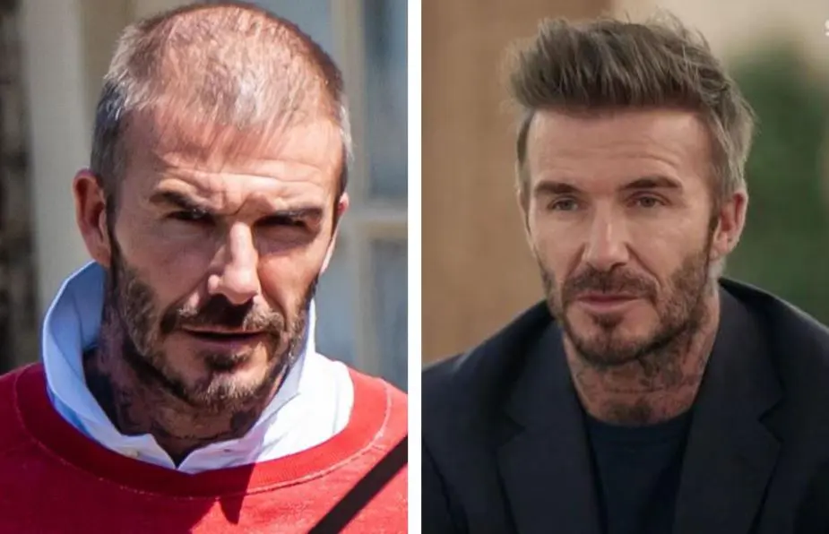 david-beckham-hair-transplant-before-and-after