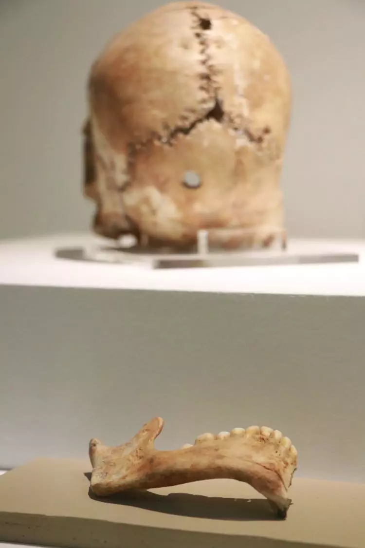 Dünyada bir ilk! İlk beyin ameliyatına ait kafatası Türkiye'de bulundu tam 10 bin 500 yıllık-1