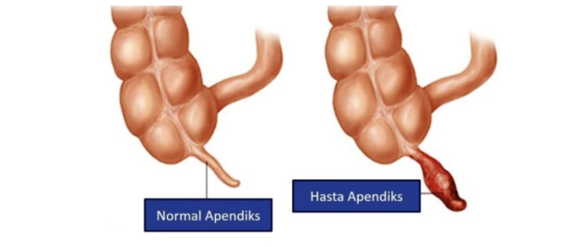 Çocuklarda Apandi̇si̇ti̇n Tani Ve Tedavi̇si̇ 2