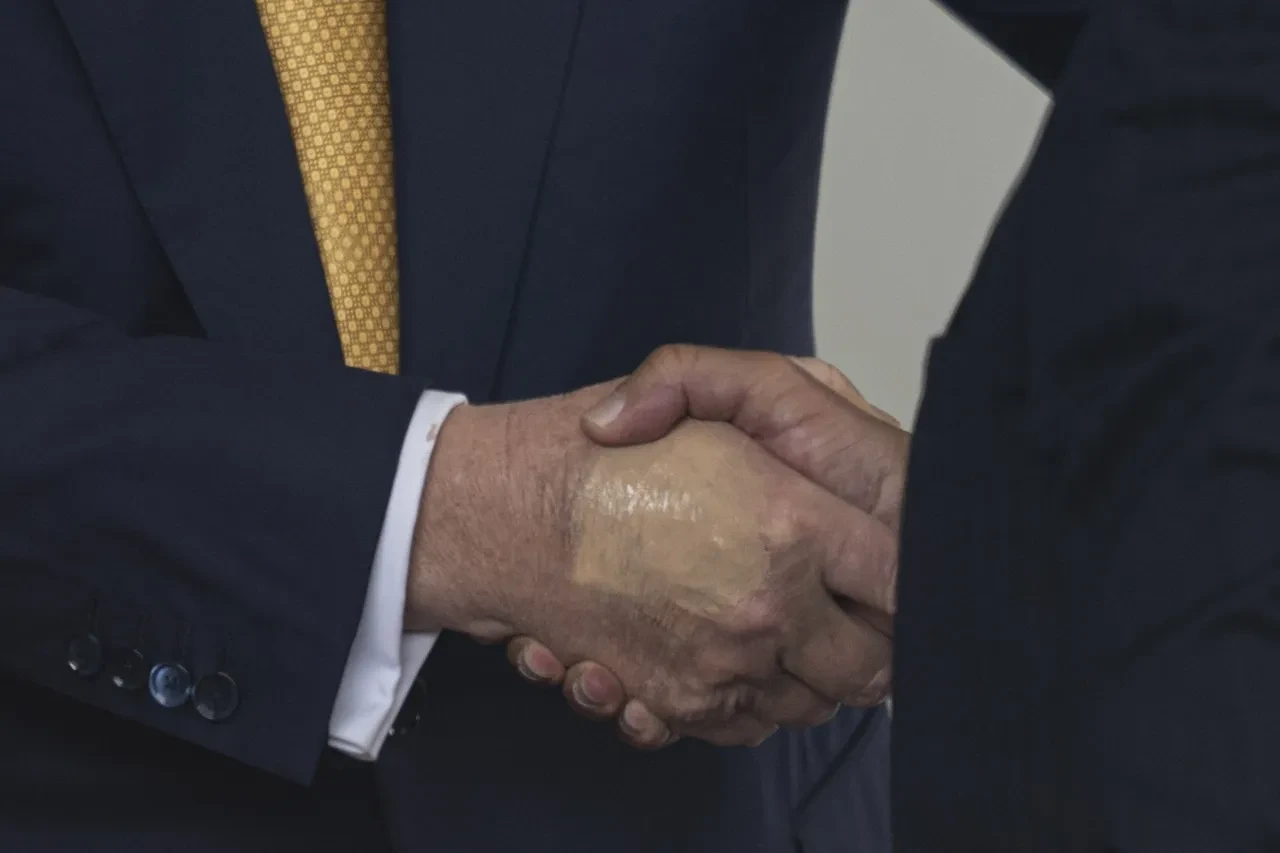 Donald Trumpin Hastaligi Aciklandi Vucudundaki Sislik Ve Morluklara Teshis Konuldu 3235048 202507180813 2